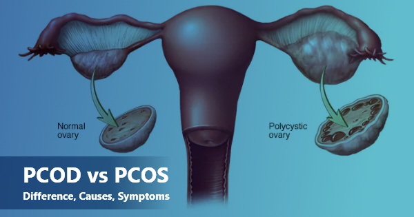 PCOS vs PCOD — Differences and the Correct Treatment Approach